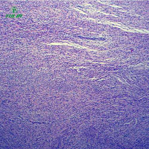 人體腫瘤病理玻片